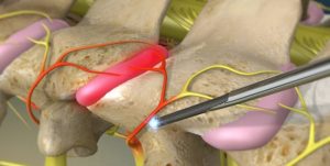 Rhizotomy
