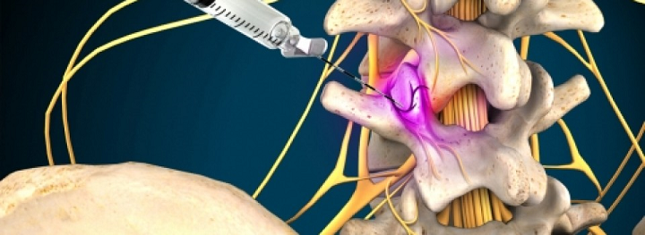 Facet Joint Blocks Center For Pain Relief