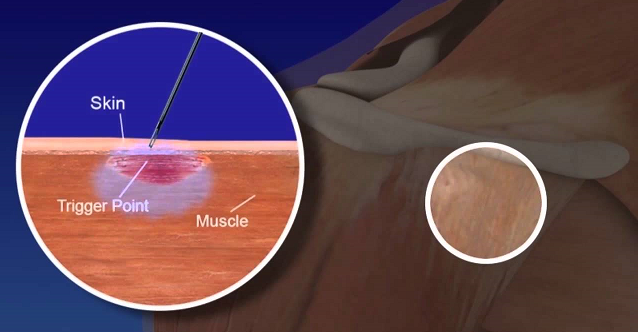 Myofascial Trigger Points and Back Pain - Propel Physiotherapy